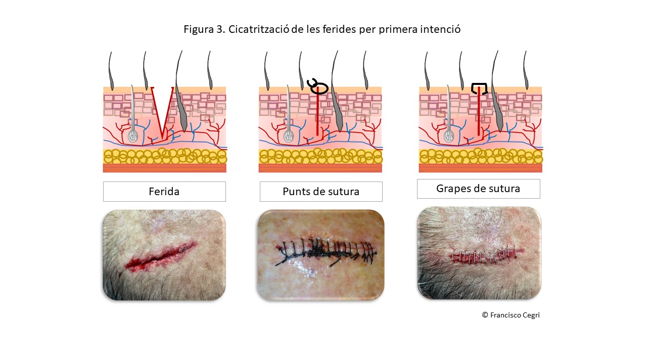 Cicatrització de les ferides per primera intenció