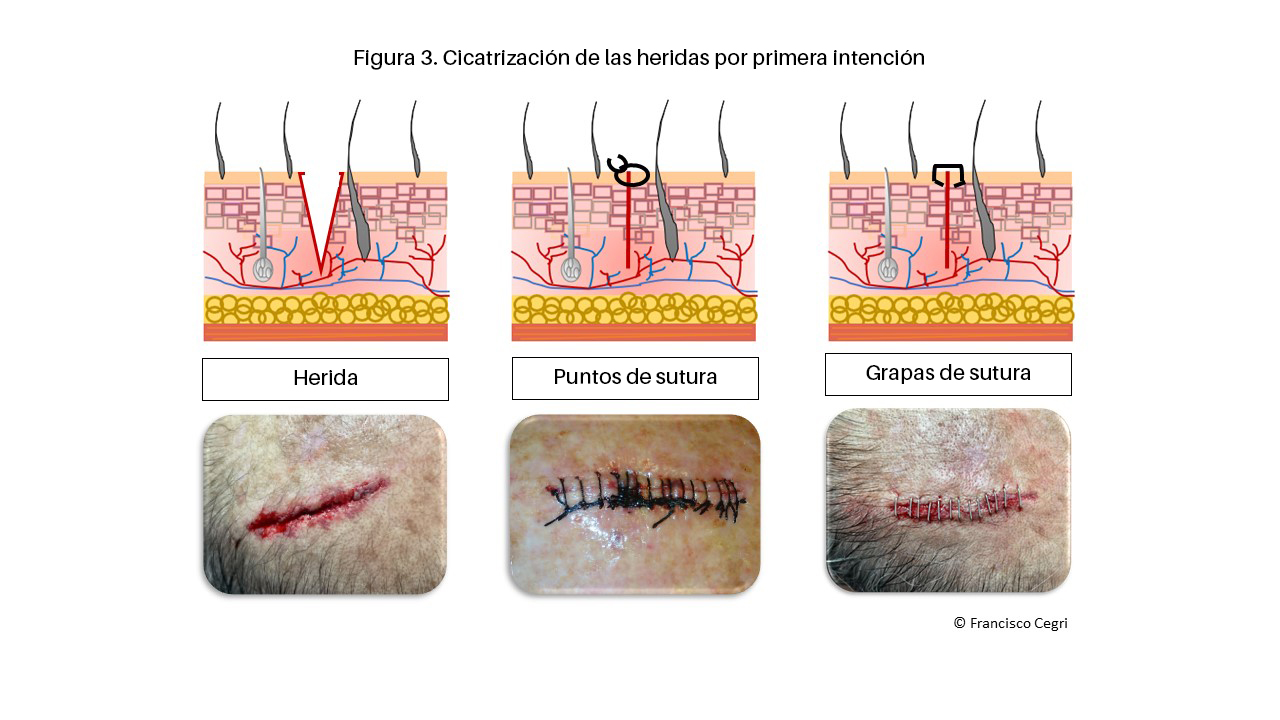 Cicatrización de las heridas por primera intención