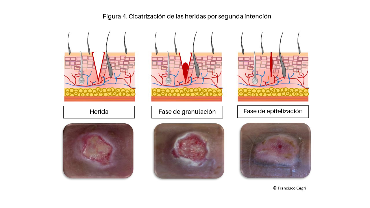 Cicatrización de las heridas por segunda intención