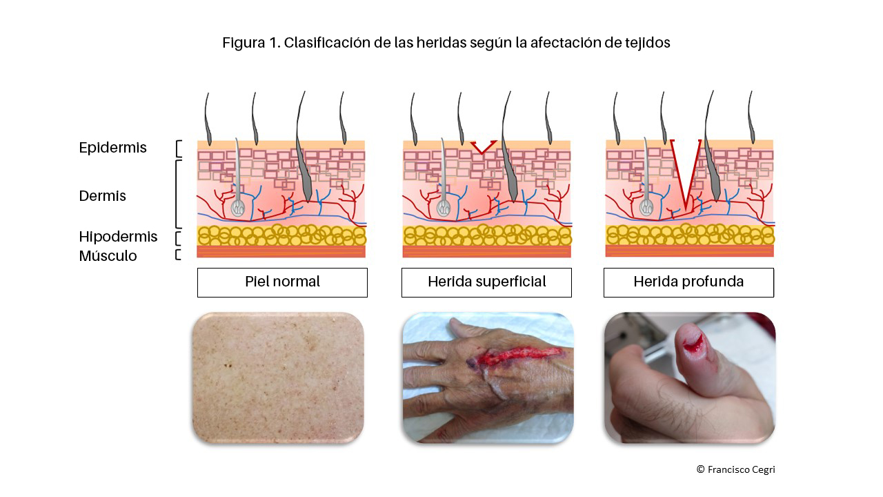 Clasificación de las heridas según la afectación de tejidosxits