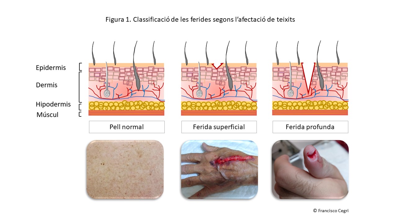 Classificació de les ferides segons afectació de teixits